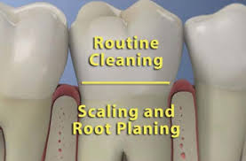 Scaling and Root Planing - Eden Prairie Chanhassen Dentist Minnesota - Dr. Chi & Dr. Derr Family Dentistry